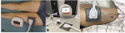 Superior Enhancement of Cutaneous Microcirculation Due to “Cyclic” Application of a Negative Pressure Wound Therapy Device in Humans – Local and Remote Effects